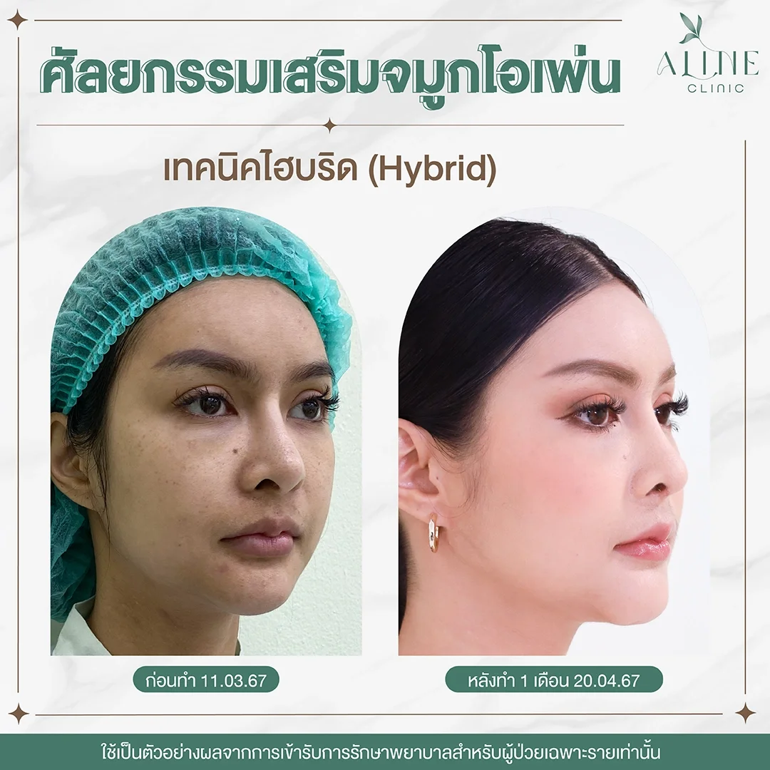 รีวิวเสริมจมูกเทคนิค